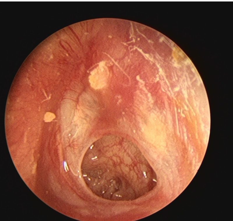 Rhinovirus cold is not flu! Blowing your nose incorrectly can lead to otitis media?-HeadTechPro